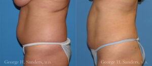 Patient 1b Liposuction Before and After