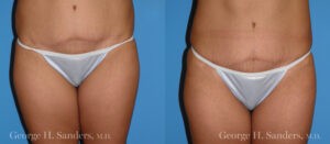 Patient 2a Liposuction Before and After