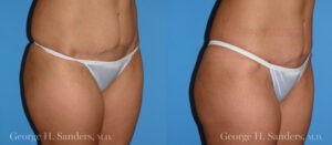 Patient 2b Liposuction Before and After
