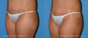 Patient 2c Liposuction Before and After