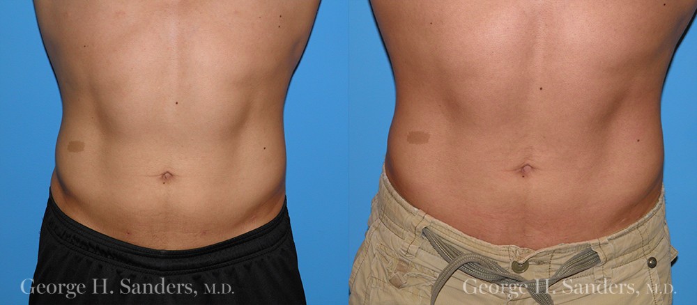 Patient 1a Male Liposuction Before and After