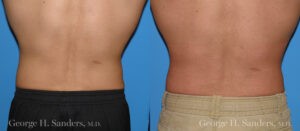 Patient 1b Male Liposuction Before and After