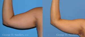 Patient 4a Liposuction Before and After