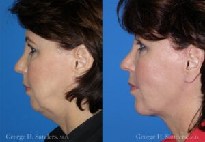 Patient 1c MACS Lift Before and After