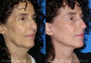 Patient 4b MACS Lift Before and After