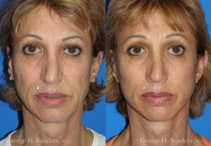 Patient 7a MACS Lift Before and After