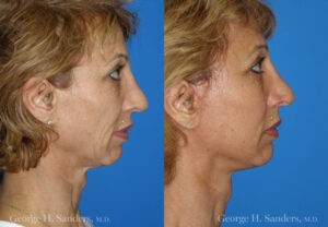Patient 7c MACS Lift Before and After