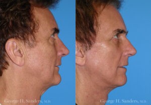 Patient 1b Male Facelift Before and After