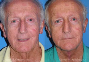 Patient 2a Male Facelift Before and After