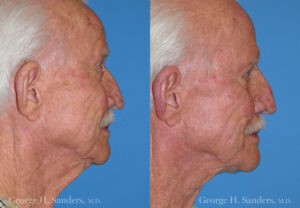 Patient 4b Male Facelift Before and After