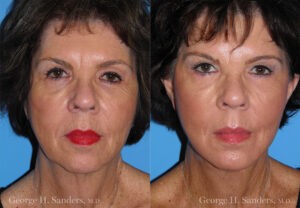 Patient 29a Laserbrasion Before and After