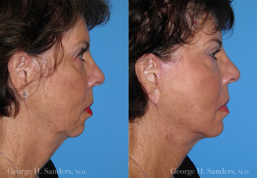 Patient 29b Laserbrasion Before and After