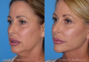Patient 2b Neck Lift Before and After