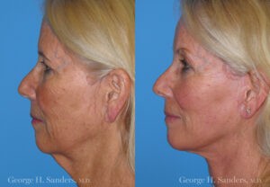 Patient 3c Neck Lift Before and After