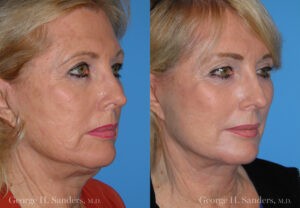 Patient 4b Neck Lift Before and After