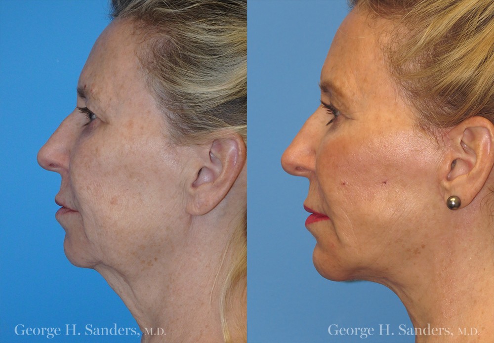 Patient 5a Neck Lift Before and After