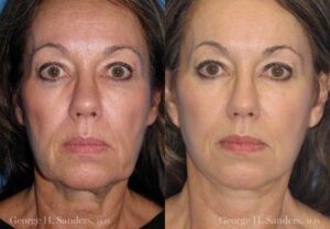Patient 6c Neck Lift Before and After