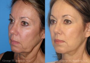 Patient 6b Neck Lift Before and After
