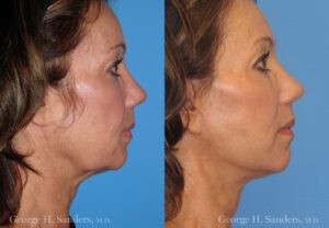 Patient 6a Neck Lift Before and After