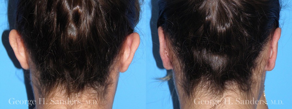 Patient 5 Otoplasty Before and After