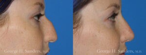 Patient 12a Rhinoplasty Before and After