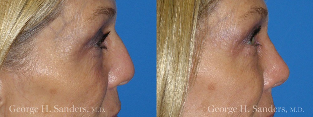 Patient 13a Rhinoplasty Before and After