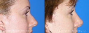 Patient 14a Rhinoplasty Before and After