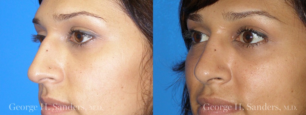 Patient 15a Rhinoplasty Before and After