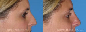 Patient 16a Rhinoplasty Before and After