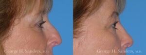 Patient 17a Rhinoplasty Before and After