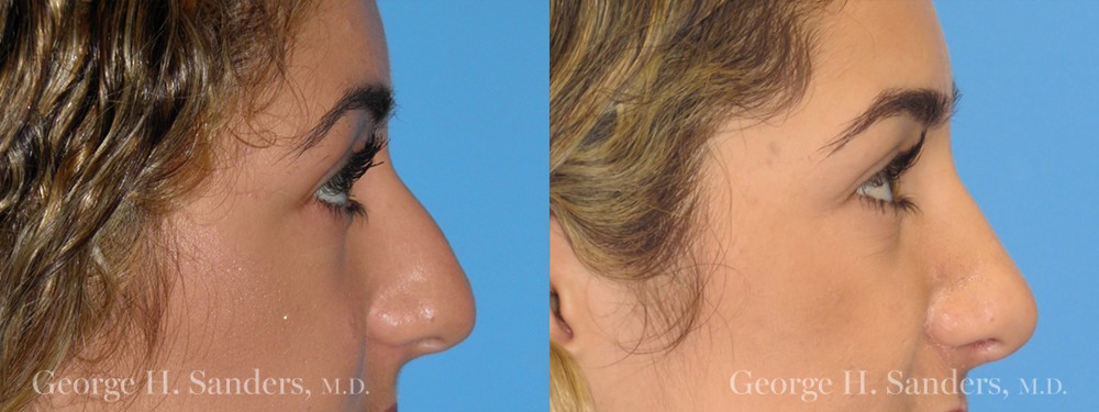 Patient 18a Rhinoplasty Before and After