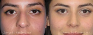 Patient 2c Rhinoplasty Before and After