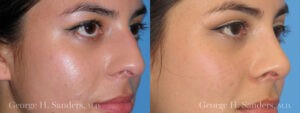 Patient 2b Rhinoplasty Before and After
