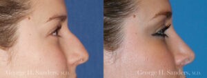 Patient 19a Rhinoplasty Before and After