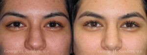 Patient 20b Rhinoplasty Before and After