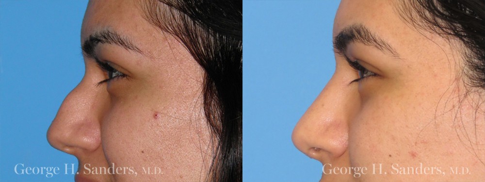 Patient 20a Rhinoplasty Before and After