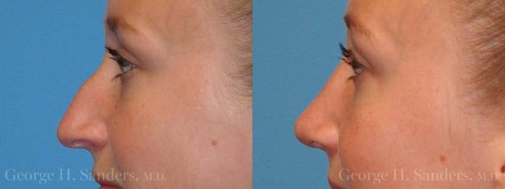 Patient 21a Rhinoplasty Before and After