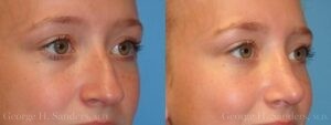 Patient 21b Rhinoplasty Before and After