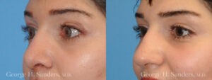 Patient 6b Rhinoplasty Before and After
