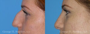 Patient 7a Rhinoplasty Before and After