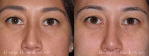 Patient 8b Rhinoplasty Before and After
