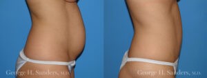 Patient 2b Tummy Tuck Before and After