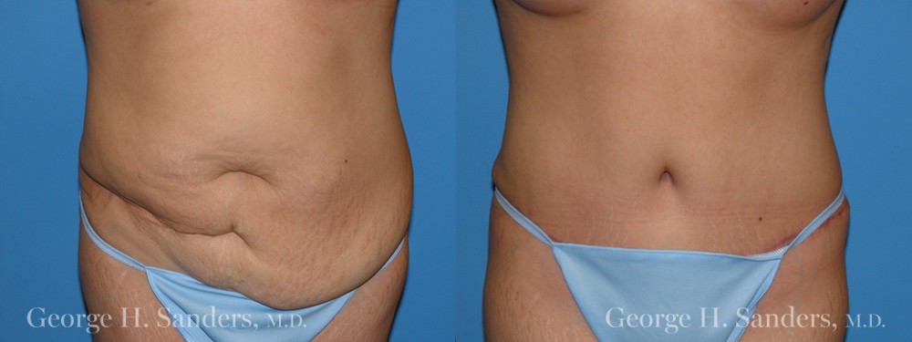 Patient 6a Tummy Tuck Before and After