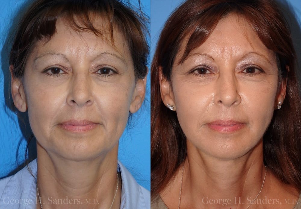 Patient 16a Face Lift Before and After