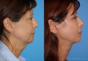 Patient 16c Face Lift Before and After