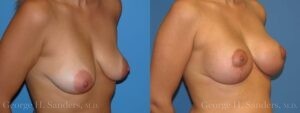 Patient 10b Breast Lift Before and After