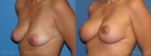 Patient 10c Breast Lift Before and After