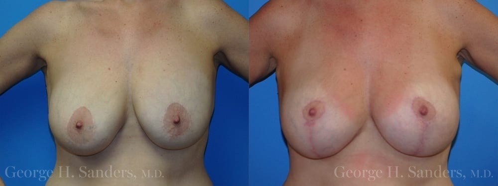 Patient 11a Breast Lift Before and After