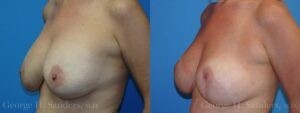 Patient 11b Breast Lift Before and After