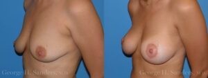 Patient 7b Breast Lift Before and After